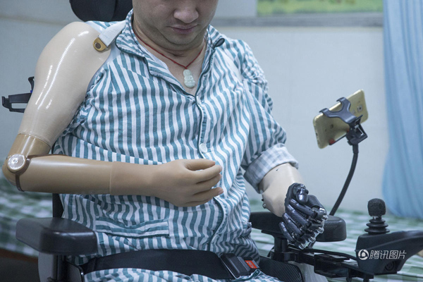 殘疾人裝上智能仿生手 能用電腦刮胡子